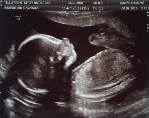 Chỉ đau vai gáy, mẹ nghĩ bình thường nhưng amp;#39;chết lặngamp;#39; khi đẻ con đã chết lưu - 3