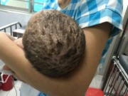 Tin tức - Tắm lá chữa thủy đậu, bé trai 4 tháng tuổi bị nhiễm độc da toàn thân