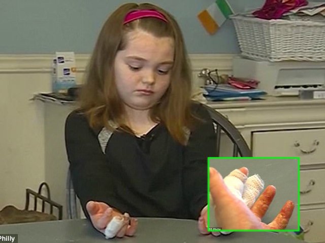 Cảnh báo: Bé gái 11 tuổi bị bỏng nặng ở tay do tiếp xúc với... hàn the