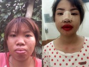 Làm đẹp - Không thể sống mãi trong diện mạo xấu xí, mẹ đơn thân Đắk Nông quyết tâm “đập mặt xây lại”