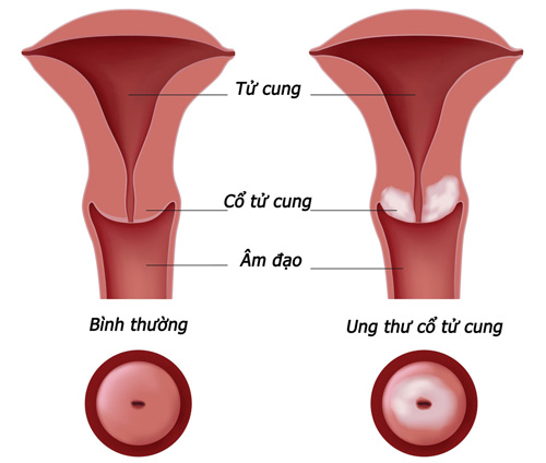 7 dấu hiệu ung thư cổ tử cung nguy hiểm, chị em nhất định không được bỏ qua - 1