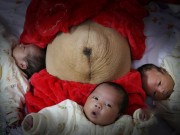 Bà bầu - Chồng nghèo xót xa vì bụng vợ thâm đen, bèo nhèo như vỏ bưởi héo sau ca sinh 3