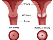 Sức khỏe - 7 dấu hiệu ung thư cổ tử cung nguy hiểm, chị em nhất định không được bỏ qua
