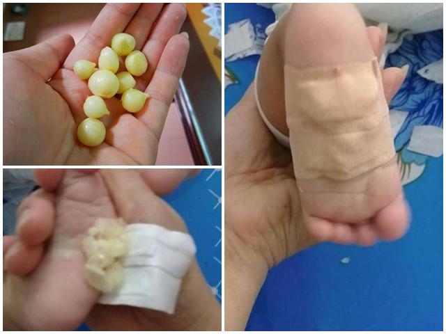 Mẹ bỉm sữa đua nhau dùng hành tăm dán lòng bàn chân giúp trị ho, sổ mũi cho trẻ