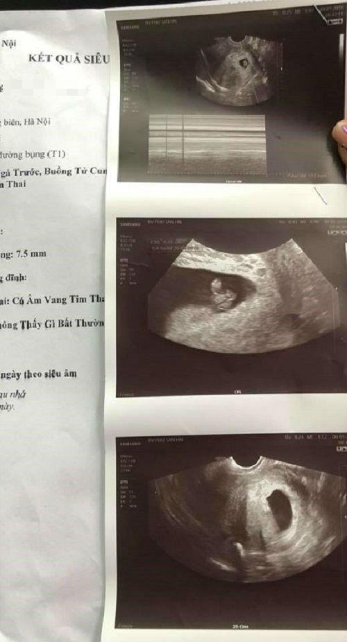 Hà Nội: Bác sĩ khẳng định thai chết lưu cho đi hút, sang viện khác khám thai vẫn bình thường - 3