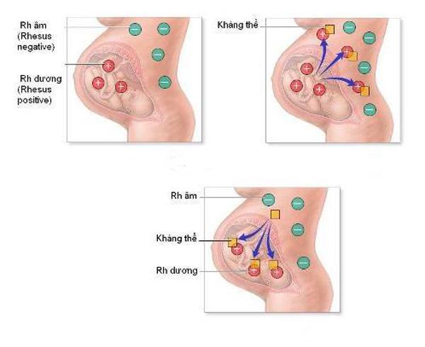 Bất đồng nhóm máu mẹ con - vấn đề nguy hiểm mọi bà bầu cần biết - 1