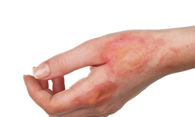 Sẹo bỏng có nặng đến mấy cũng hết nếu áp dụng mẹo sau! - 1