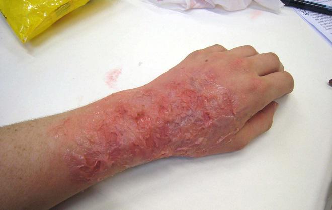 Sẹo bỏng có nặng đến mấy cũng hết nếu áp dụng mẹo sau! - 8