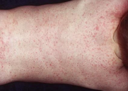 Mẹ nên làm gì khi trẻ sơ sinh bị sốt phát ban? - 1