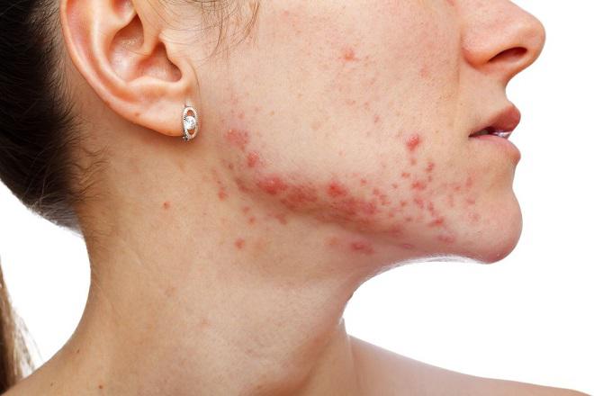 Dù kết hợp nguyên liệu gì với mật ong cũng có thể chế ra amp;#34;thần dượcamp;#34; trị mụn - 1
