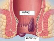 Sức khỏe - Dân văn phòng nên làm gì để khắc phục bệnh trĩ?