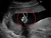 Bà bầu - Chắc hẳn bố mẹ nào cũng mong đi siêu âm được thấy con vẫy chào, vỗ tay thế này!