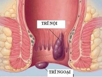 Dân văn phòng nên làm gì để khắc phục bệnh trĩ?