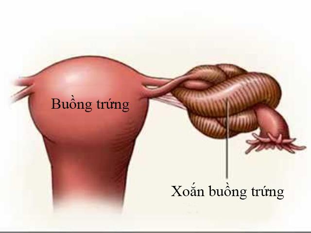 Xoắn buồng trứng bệnh phụ khoa ảnh hưởng đến sinh sản của phụ nữ - 1