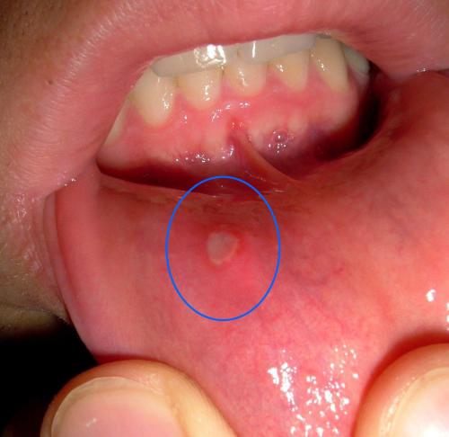 Nguyên nhân gây loét miệng ở trẻ em và cách điều trị tại nhà - 1