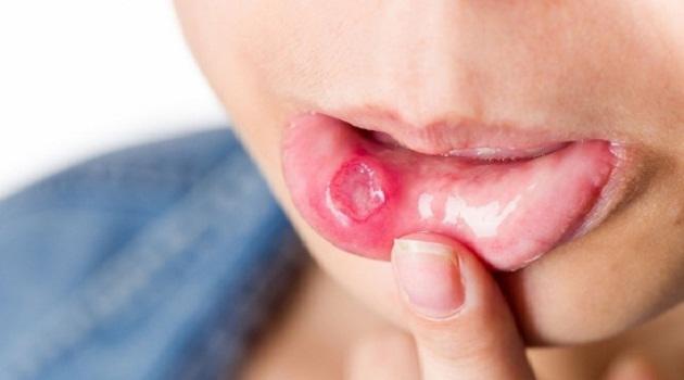 Nguyên nhân gây loét miệng ở trẻ em và cách điều trị tại nhà - 2