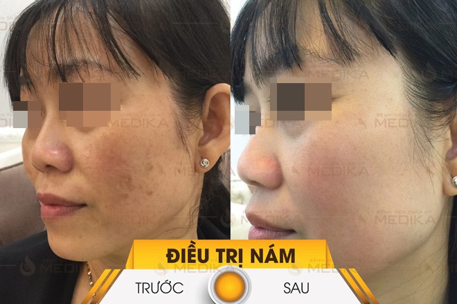 Chỉ còn 1 tuần là đến Tết, chị em phải làm gì để đánh bay nám trong 1 nốt nhạc? - 3