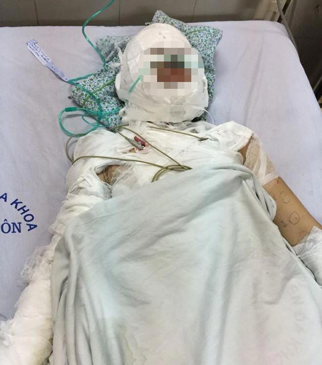 Hà Nội: Cô gái bị người đàn ông ngoại quốc tẩm xăng đốt cháy như ngọn đuốc - 2