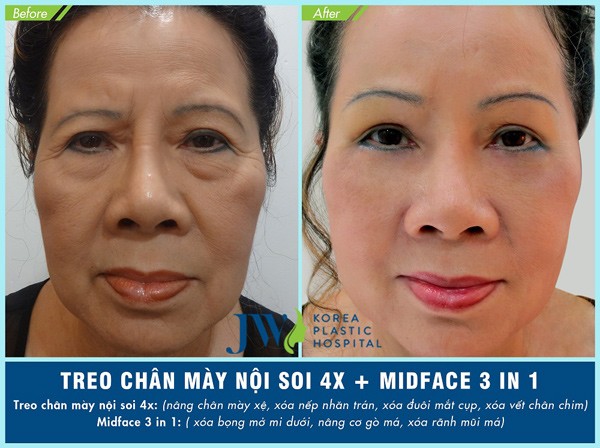 Treo chân mày nội soi 4X: Tuổi ngoài 60 trở về 30 - 1