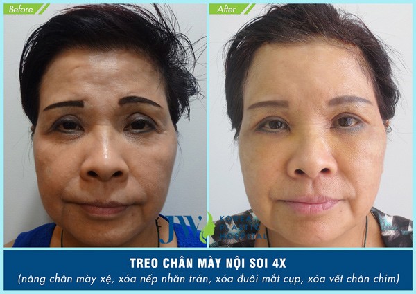 Treo chân mày nội soi 4X: Tuổi ngoài 60 trở về 30 - 2
