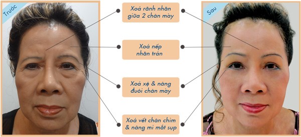 Treo chân mày nội soi 4X: Tuổi ngoài 60 trở về 30 - 3