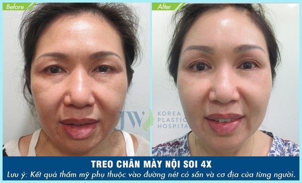 Treo chân mày nội soi 4X: Tuổi ngoài 60 trở về 30 - 5