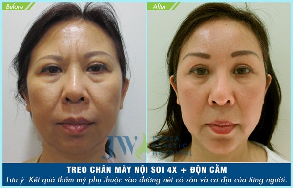 Treo chân mày nội soi 4X: Tuổi ngoài 60 trở về 30 - 6