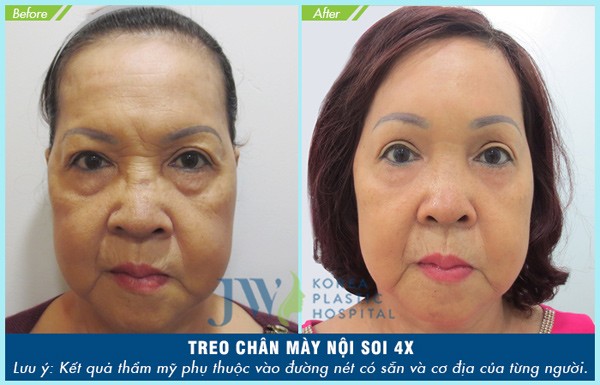 Treo chân mày nội soi 4X: Tuổi ngoài 60 trở về 30 - 7