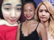 Đẹp - Từ mỹ nữ xứ Hàn đến Mai Ngô chuẩn Việt, ai ai cũng từng một thời mặt mụn ê chề!