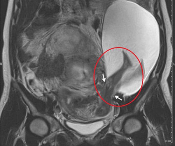 Không ngờ cú đá của em bé trong bụng mẹ lại mạnh đến mức này! - 4