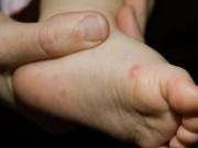 Làm mẹ - Trẻ bị tay chân miệng bao lâu thì khỏi?