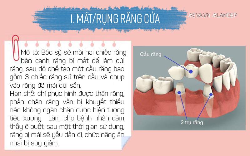 Thao tác mài răng để làm trụ cầu ít nhiều sẽ làm ảnh hưởng đến cấu trúc của răng.
