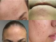 Làm đẹp - Mụn ẩn đến thăm, làm sao để trị một cách triệt để kẻ thù "đáng ghét" này?