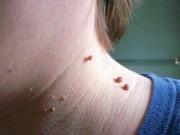 Làm đẹp - Bỏ túi cách mụn thịt tận gốc bằng bí quyết công thức dân gian