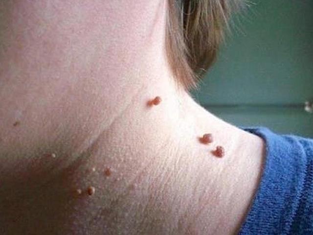 Bỏ túi cách trị mụn thịt tận gốc bằng bí quyết công thức dân gian