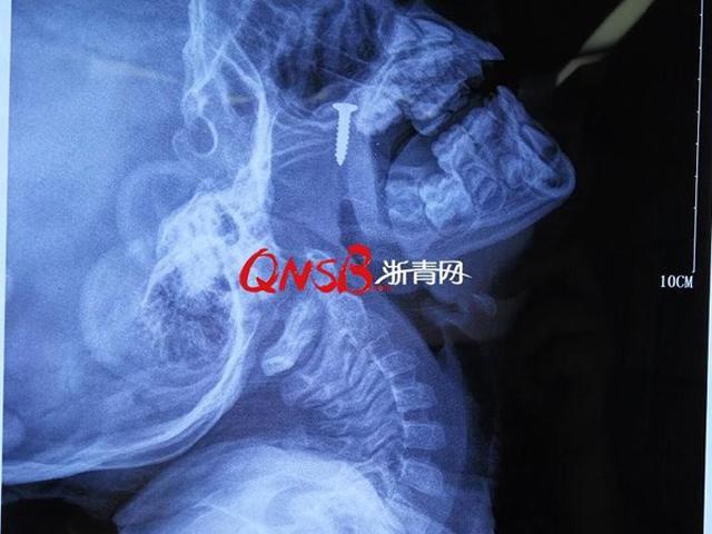 Con trai 4 tuổi kêu khó thở và đau mũi, mẹ 