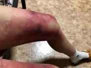 Sức khỏe - Nữ sinh viên suýt mất chân vì thói quen ăn mặc kiểu “thời trang phang thời tiết”