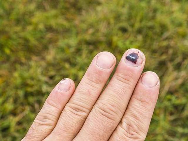 6 dấu hiệu khác lạ của móng tay tưởng đơn giản nhưng cực nguy hiểm