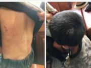 Tin tức - Bé 6 tuổi bị bố dượng đánh đến ngất xỉu, mẹ đẻ còn nhẫn tâm xát muối vào vết thương