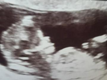 Mãn kinh từ khi 11 tuổi, cô gái trẻ mừng rơi nước mắt khi bất ngờ có thai