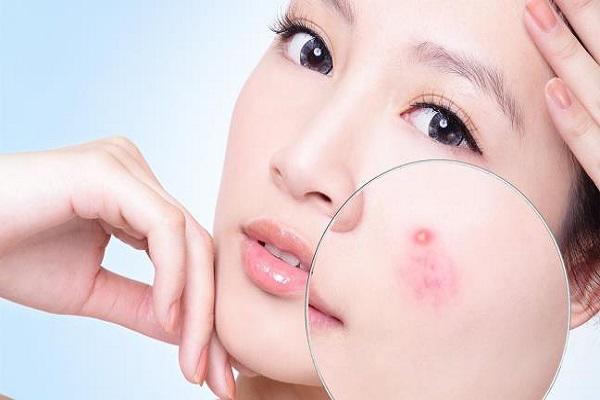 Trị mụn ẩn dưới da siêu hiệu quả từ những bí quyết thần thánh sau - 1