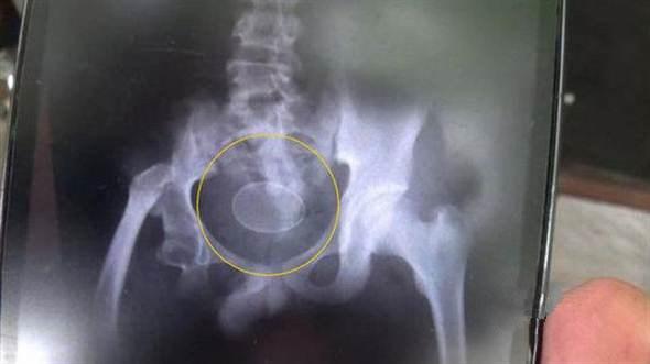 Kỳ lạ cậu bé 12 tuổi một tuần... đẻ ra 7 quả trứng - 2