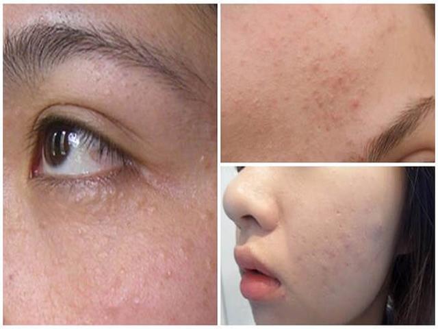 Trị mụn ẩn dưới da siêu hiệu quả từ những bí quyết thần thánh sau