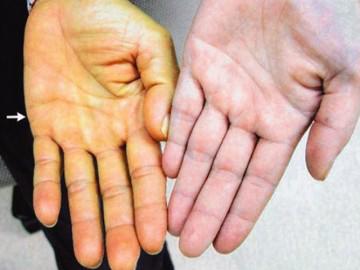 Da vàng, mắt vàng có phải bệnh gan?