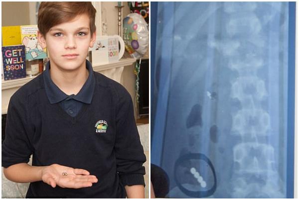 Cậu bé 12 tuổi thủng dạ dày vì món đồ chơi được triệu trẻ em yêu thích - 1