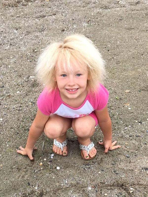 Bé gái 6 tuổi có mái tóc amp;#34;bất trịamp;#34; như thiên tài Einstein vì mắc hội chứng cực hiếm - 1