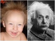 Sức khỏe - Bé gái 6 tuổi có mái tóc "bất trị" như thiên tài Einstein vì mắc hội chứng cực hiếm