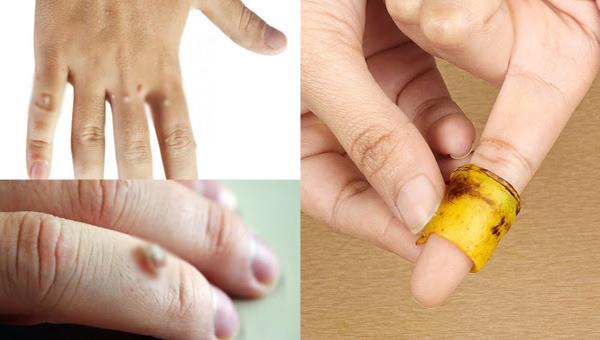 Tổng hợp cách trị mụn cóc an toàn - hiệu quả ngay từ lần đầu tiên! - 3