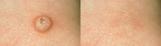 Tổng hợp cách trị mụn cóc an toàn - hiệu quả ngay từ lần đầu tiên! - 1