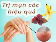 Làm đẹp - Tổng hợp cách trị mụn cóc an toàn - hiệu quả ngay từ lần đầu tiên!
